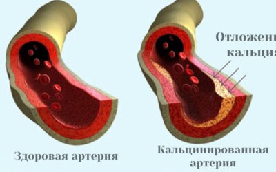 КАЛЬЦИФИКАЦИЯ АРТЕРИЙ