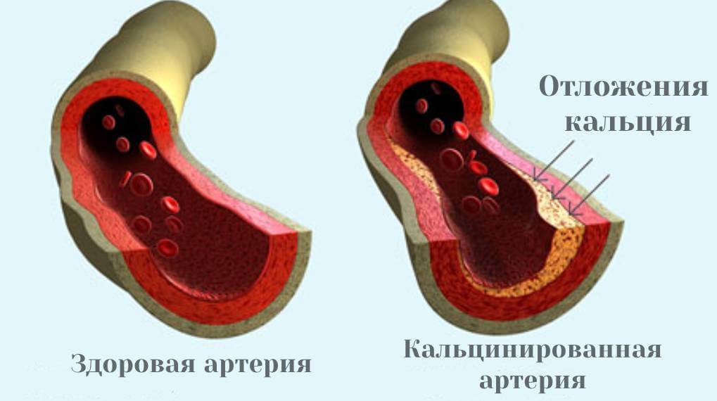 КАЛЬЦИФИКАЦИЯ АРТЕРИЙ